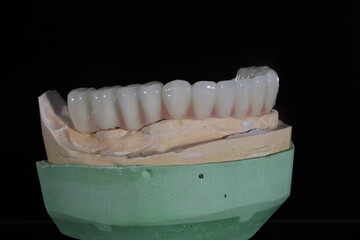 Full-arch porcelain implant-supported dental prosthesis for edentulous jaws with All-on-X and All-on-4 treatment procedure using dental implant surgery.