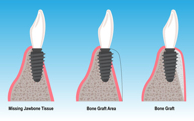Bone grafting treatment for bone tissue loss and resorption in dental implant treatment. Intraosseous dental implant treatment. Jawbone resorption. Dental before after