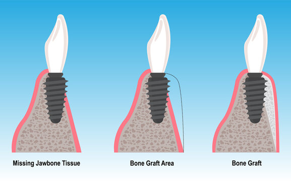 Bone grafting treatment for bone tissue loss and resorption in dental implant treatment. Intraosseous dental implant treatment. Jawbone resorption. Dental before after