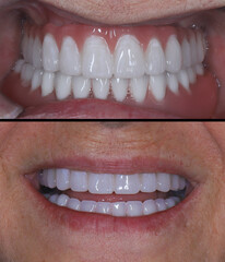 Full arch dental prosthesis supported by implants for an edentulous jaw, using bone level dental...
