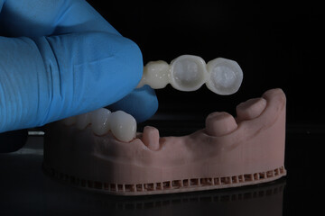 3D-printed jaw model and full-mouth zirconium porcelain crowns. Computer-assisted smile design treatment. dental before after.  © UniqDream