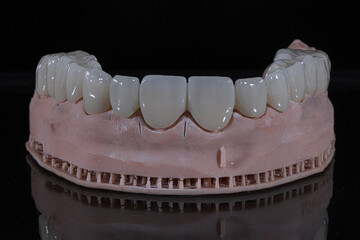 3D-printed jaw model and full-mouth zirconium porcelain crowns. Computer-assisted smile design treatment. dental before after.  © UniqDream