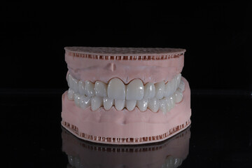 3D-printed jaw model and full-mouth zirconium porcelain crowns. Computer-assisted smile design treatment. dental before after.  © UniqDream