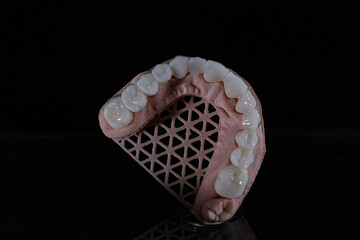 3D-printed jaw model and full-mouth zirconium porcelain crowns. Computer-assisted smile design treatment. dental before after.  © UniqDream