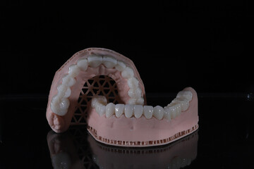 3D-printed jaw model and full-mouth zirconium porcelain crowns. Computer-assisted smile design treatment. dental before after.  © UniqDream