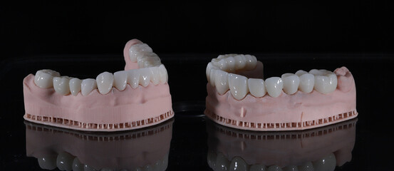 3D-printed jaw model and full-mouth zirconium porcelain crowns. Computer-assisted smile design treatment. dental before after.  © UniqDream