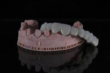 3D-printed jaw model and full-mouth zirconium porcelain crowns. Computer-assisted smile design treatment. dental before after.  © UniqDream