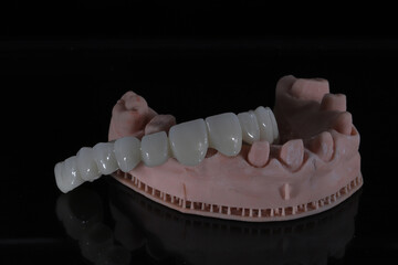3D-printed jaw model and full-mouth zirconium porcelain crowns. Computer-assisted smile design treatment. dental before after.  © UniqDream
