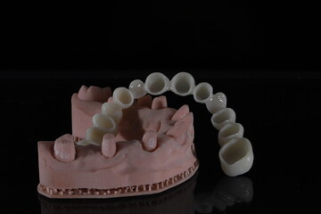 3D-printed jaw model and full-mouth zirconium porcelain crowns. Computer-assisted smile design treatment. dental before after.  © UniqDream