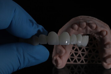 3D-printed jaw model and full-mouth zirconium porcelain crowns. Computer-assisted smile design treatment. dental before after.  © UniqDream