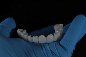 3D-printed jaw model and full-mouth zirconium porcelain crowns. Computer-assisted smile design treatment. dental before after.  © UniqDream