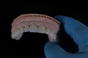 3D-printed jaw model and full-mouth zirconium porcelain crowns. Computer-assisted smile design treatment. dental before after.  © UniqDream