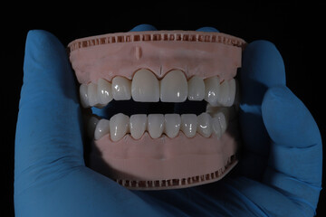 3D-printed jaw model and full-mouth zirconium porcelain crowns. Computer-assisted smile design treatment. dental before after.  © UniqDream