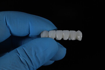 E-max or zirconia glass ceramic porcelain bridge crown treatment and implant-supported crown treatment used in dental dentistry for cases of tooth loss. Smile design. © UniqDream