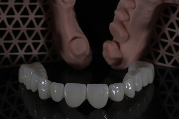 Dental zirconium porcelain crowns placed on a digital model. Aesthetic visual with dental smile design. © UniqDream