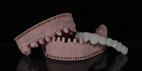Dental zirconium porcelain crowns placed on a digital model. Aesthetic visual with dental smile design. © UniqDream