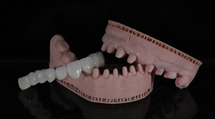 Dental zirconium porcelain crowns placed on a digital model. Aesthetic visual with dental smile design. © UniqDream