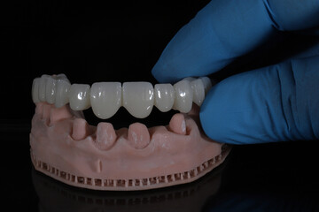 Dental zirconium porcelain crowns placed on a digital model. Aesthetic visual with dental smile design.