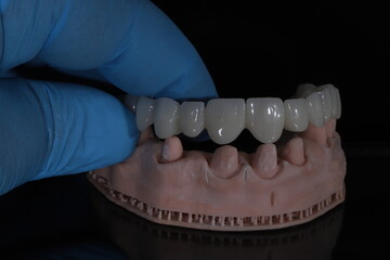 Dental zirconium porcelain crowns placed on a digital model. Aesthetic visual with dental smile design. © UniqDream