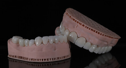 Dental zirconium porcelain crowns placed on a digital model. Aesthetic visual with dental smile design. © UniqDream
