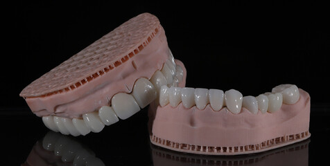 Dental zirconium porcelain crowns placed on a digital model. Aesthetic visual with dental smile design. © UniqDream