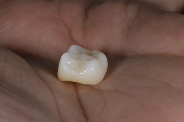 Bridge crown prosthesis treatment in dental aesthetic dentistry for missing teeth. Zirconium porcelain bridge treatment and E-max porcelain tooth coating. © UniqDream