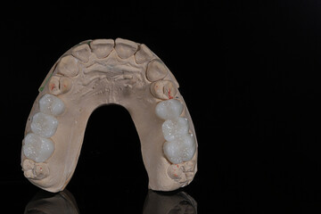 Bridge crown prosthesis treatment in dental aesthetic dentistry for missing teeth. Zirconium porcelain bridge treatment and E-max porcelain tooth coating. © UniqDream