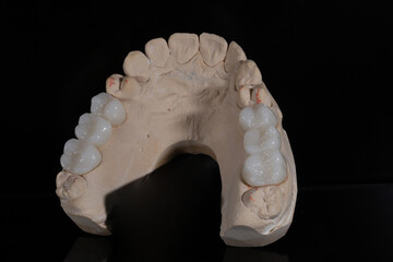 Bridge crown prosthesis treatment in dental aesthetic dentistry for missing teeth. Zirconium porcelain bridge treatment and E-max porcelain tooth coating. © UniqDream