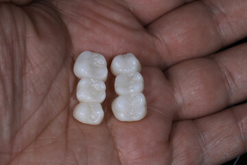 E-max or zirconia glass ceramic porcelain bridge crown treatment and implant-supported crown treatment used in dental dentistry for cases of tooth loss. Smile design. © UniqDream