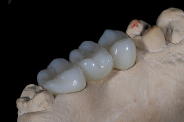 Bridge crown prosthesis treatment in dental aesthetic dentistry for missing teeth. Zirconium porcelain bridge treatment and E-max porcelain tooth coating. © UniqDream