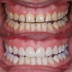 In dental aesthetic dentistry, smile design treatment with laminate veneers and zirconium crowns. Smile makeover dental before and after. © UniqDream
