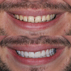 In dental aesthetic dentistry, smile design treatment with laminate veneers and zirconium crowns. Smile makeover dental before and after. © UniqDream