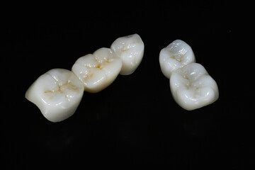 Bridge crown prosthesis treatment in dental aesthetic dentistry for missing teeth. Zirconium porcelain bridge treatment and E-max porcelain tooth coating. © UniqDream