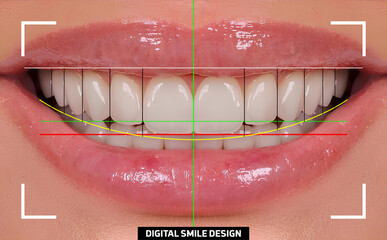 In aesthetic dentistry, smile design treatment involves creating a beautiful smile using computer-aided dental design programs. The design is achieved using E-max and zirconium materials.  © UniqDream