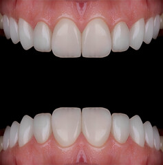 In aesthetic dentistry, smile design treatment involves creating a beautiful smile using computer-aided dental design programs. The design is achieved using E-max and zirconium materials.  © UniqDream