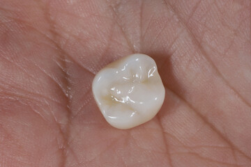 Bridge crown prosthesis treatment in dental aesthetic dentistry for missing teeth. Zirconium porcelain bridge treatment and E-max porcelain tooth coating. © UniqDream