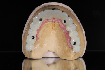 Full-arch dental prosthesis torque wrench and dental implant wrench designed for the edentulous jaw...