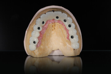 Full-arch dental prosthesis torque wrench and dental implant wrench designed for the edentulous jaw of toothless patients. Dental prosthesis. dental before after smile makeover e-max
