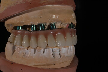 Full-arch porcelain implant-supported dental prosthesis for edentulous jaws with All-on-X and All-on-4 treatment procedure using dental implant surgery.