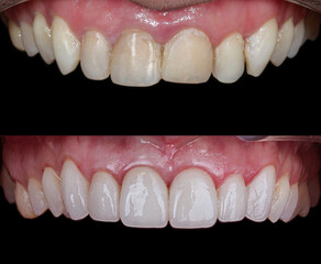 Aesthetic smile design treatment in dental dentistry. Dental treatment with laminate veneers, dental implants, and porcelain crowns. Smile makeover and dental before and after.   © UniqDream