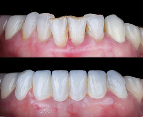 Aesthetic smile design treatment in dental dentistry. Dental treatment with laminate veneers, dental implants, and porcelain crowns. Smile makeover and dental before and after.   © UniqDream
