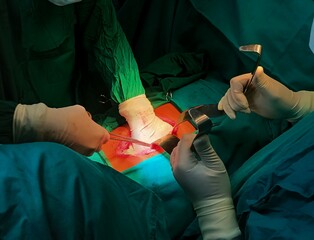 Surgery of abdominal, Resection of Small Bowels with Ligation of vessels during operation. Step by step surgery.