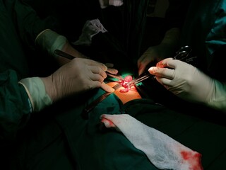 Surgery of abdominal, Resection of Small Bowels with Ligation of vessels during operation. Step by step surgery.