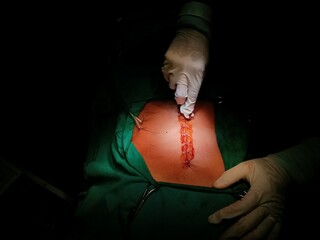 Surgery of abdominal, Resection of Small Bowels with Ligation of vessels during operation. Step by step surgery.