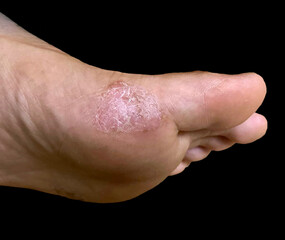 Closeup of a dry, scaly eczema patch with discoloration on the surface of foot.