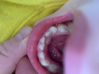 Close-up dental image showing 