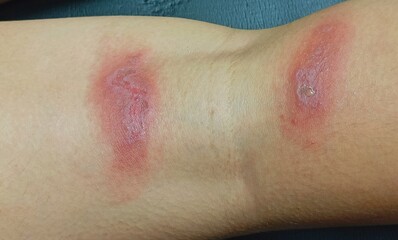 Rove beetles cause a burning sensation, and a rash of blisters. Rove beetles have a toxin in them,...