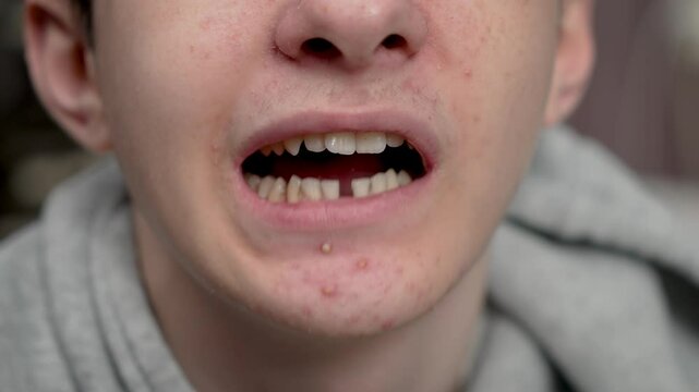 Plaque and cavities on teeth, crooked dental alignment in teenager. Tooth decay and plaque buildup, along with misaligned teeth in adolescent. Crooked teeth and signs of cavities with plaque on