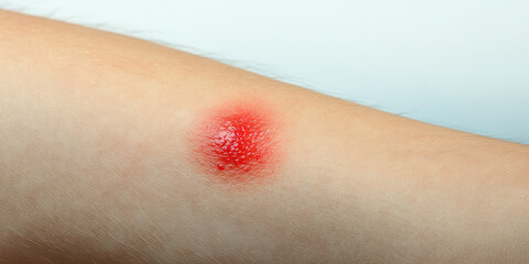 Closeup a red bump on a persons arm. Skin diseases, dermatology, allergy or skin infection, exacerbation of disease, insect bite