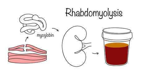 Rhabdomyolysis